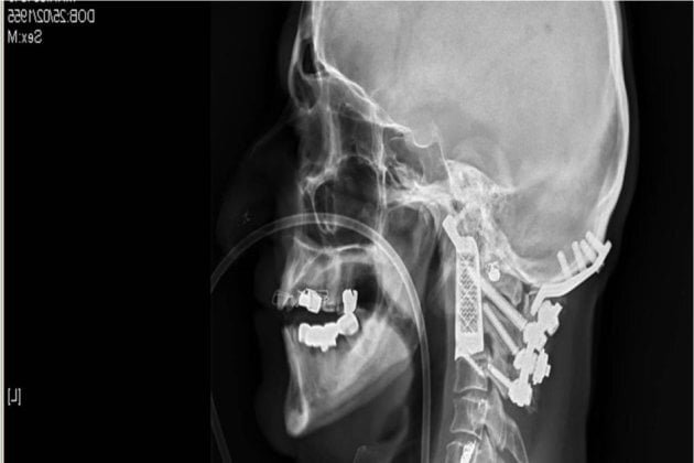 vertebre artificiale, realizate la imprimanta 3D