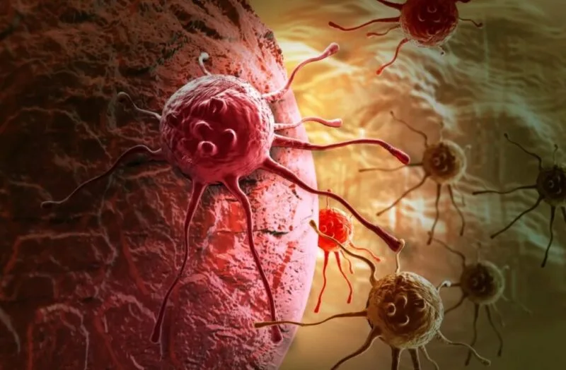 cancer de colon