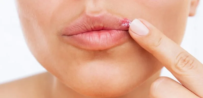 herpes Alzheimer