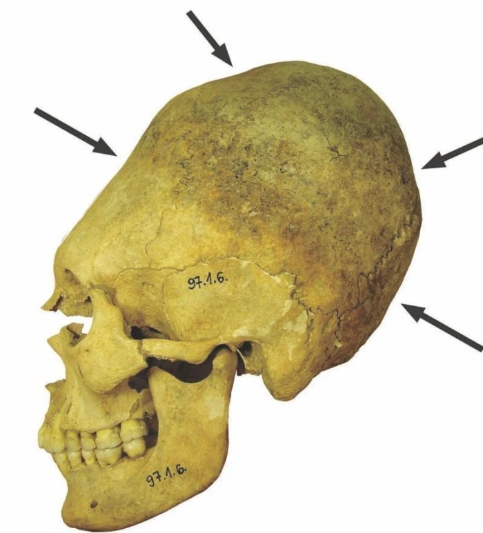 cranii alungite Misterul craniilor alungite descoperite în Ungaria. Experții, bulversați de cimitirul antic