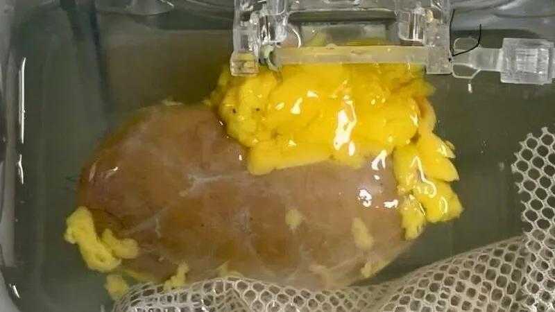 transplantul de rinichi