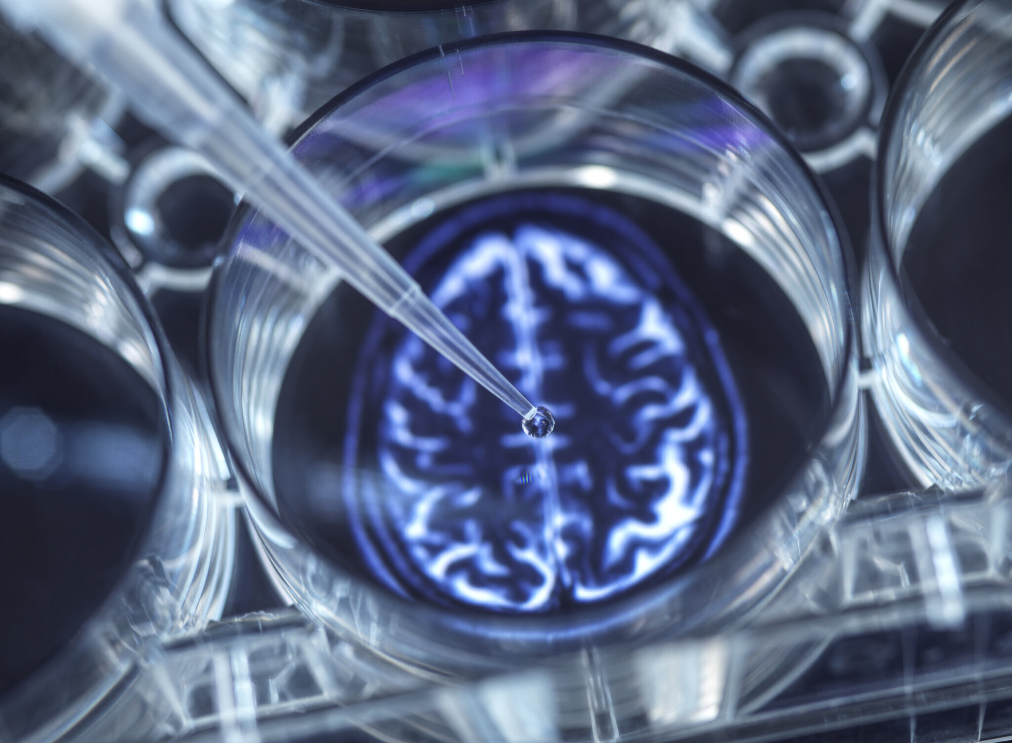 implant cerebral
