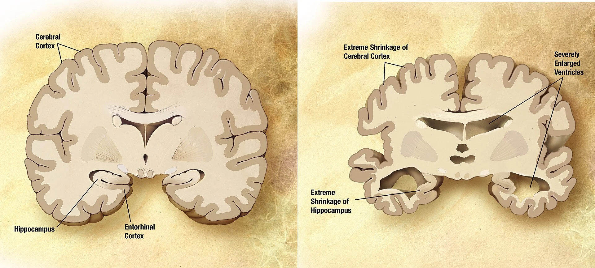 Comparație între un creier sănătos și unul cu Alzheimer, în contextul studiilor despre vitamina D și declinul cognitiv