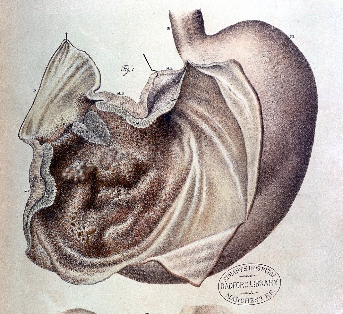 Ilustrație medicală a unui stomac afectat de cancer gastric